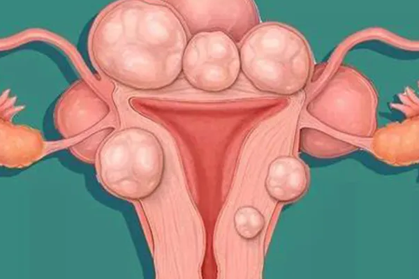 子宫肌瘤降低试管成功率不可信，但后果竟是胎位不正！